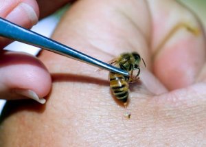 bee_venom_therapy-spl